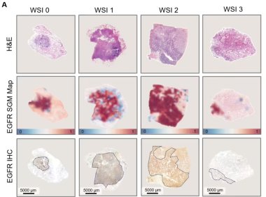 AI病理大模型突破：仅需切片图像1分钟预测肺癌基因突变